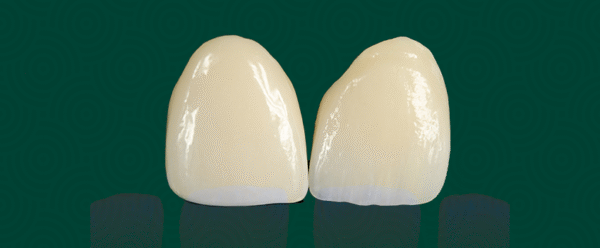 facetas dentárias